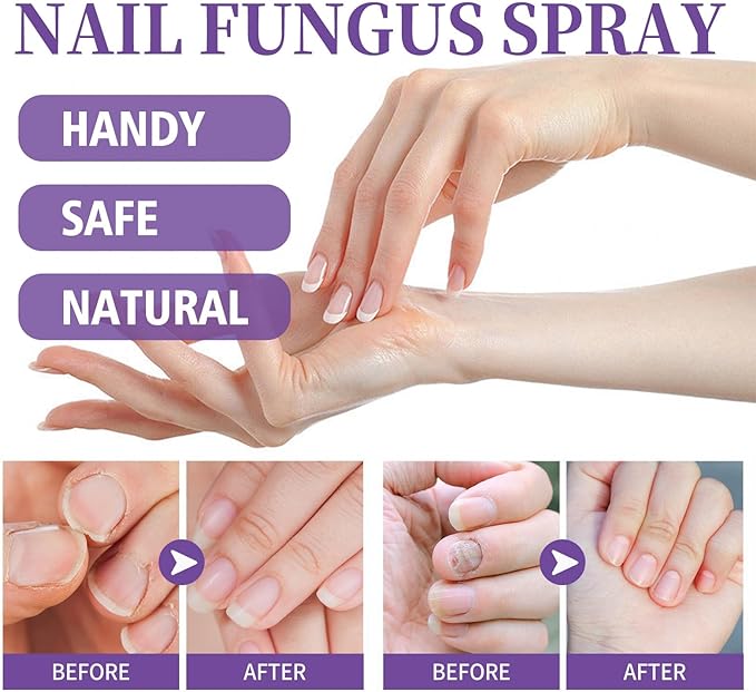 Nail Fungus Spray - Kbr Express