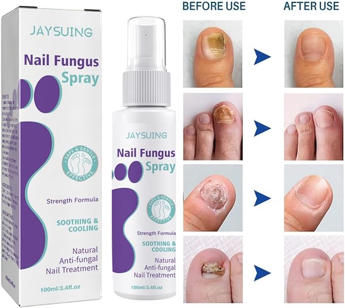 Nail Fungus Spray - Kbr Express